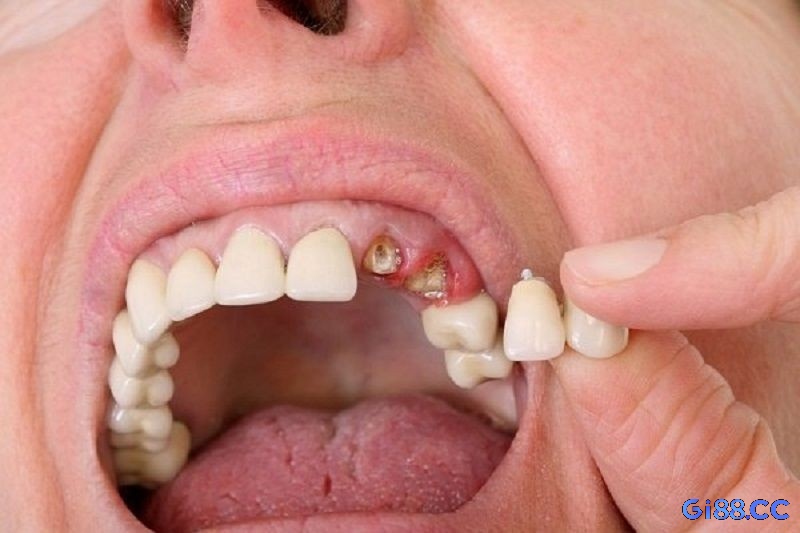 Mơ thấy rụng răng số lượng nhiều liên quan đến cảm giác mất kiểm soát hoàn toàn trong cuộc sống