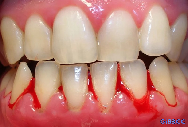Giấc mơ thấy rụng răng kèm theo máu thường mang ý nghĩa về tổn thất và nỗi đau