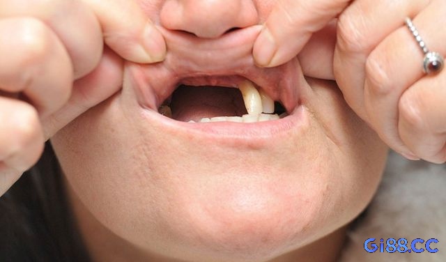Giải mã giấc mơ thấy rụng răng của thần kinh học liên quan đến giấc mơ về việc rụng răng chi tiết tại gi88